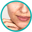 Oily and acne-prone skin